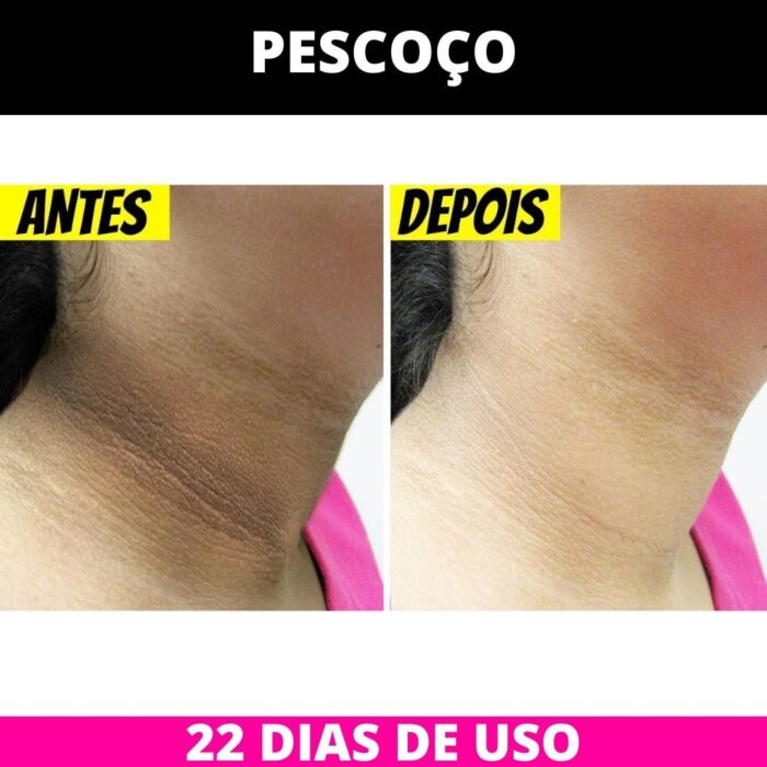 Creme Clareador de Pele Contra Manchas e Melasma 250g - Image 6